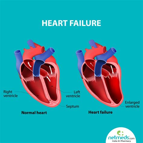 lv dysfunction medical abbreviation|severely decreased lv systolic function.